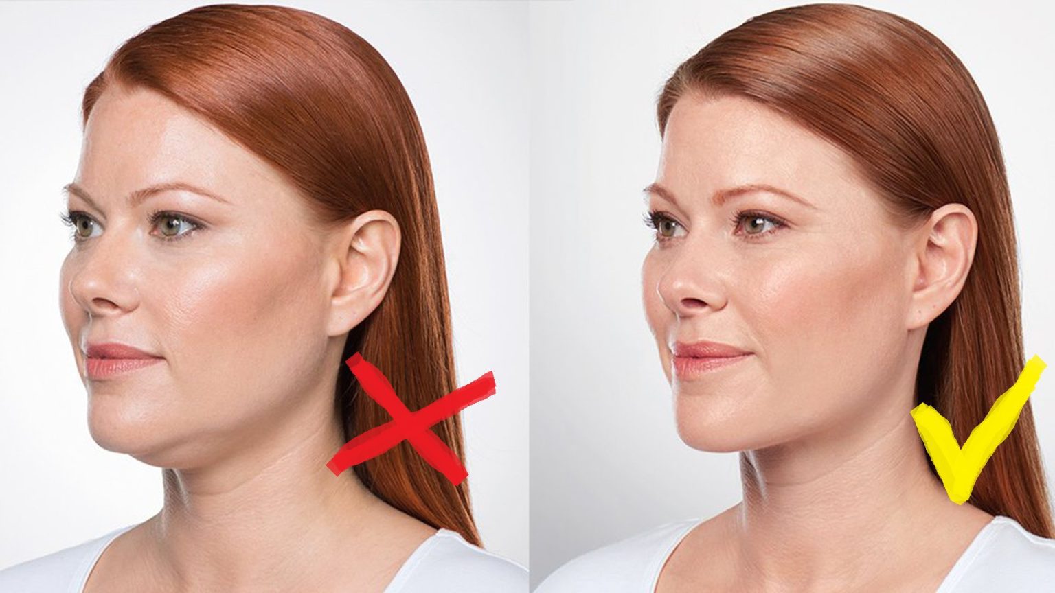 Kybella Before and After: Understanding the Recovery Process