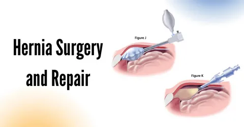 Hernia Repair Auckland: What You Need to Know Before Surgery